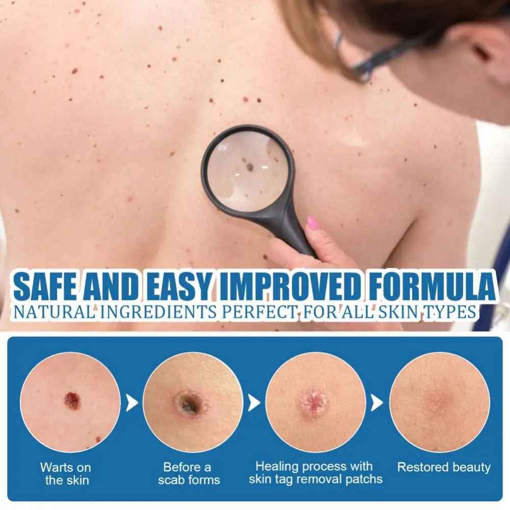 66 Pcs Skin Tag Remover Patch for Face and Body Painless Mole and Wart Removal Treatment - Image 2