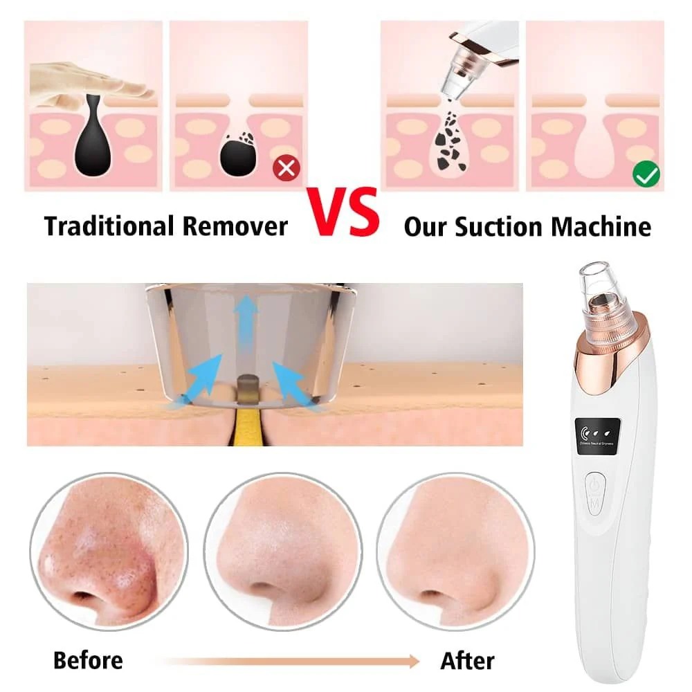 Electric Blackhead Remover | Vacuum Acne & Pore Cleaner | 5 Heads Suction Machine | Skin Care & Exfoliating Tool - Image 2